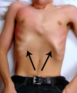 Picture-of-Flared-Ribs